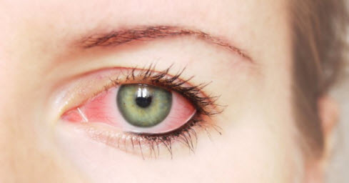 Sindrom Dry Eye